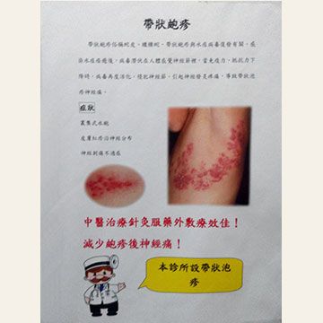 帶狀泡疹治療-小.jpg